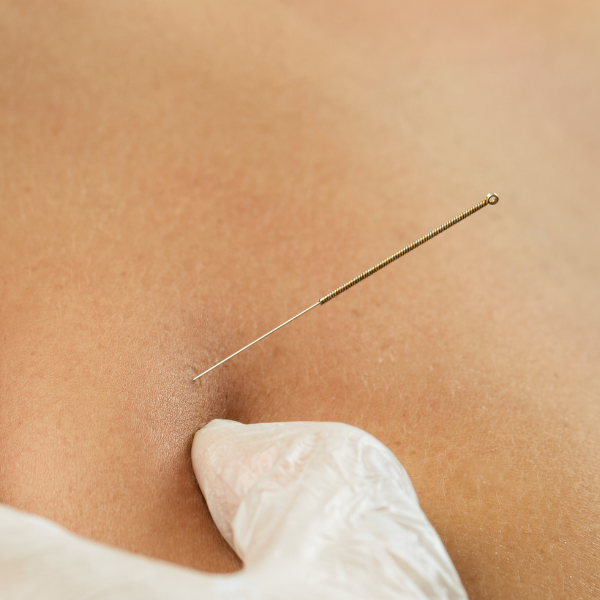 Dry needle being placed into the skin by a gloved physiotherapist